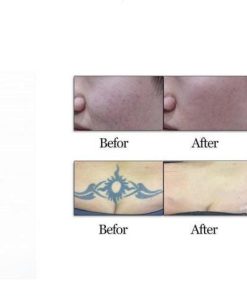 Trước và sau khi điều trị