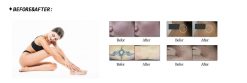 Trước và sau khi điều trị