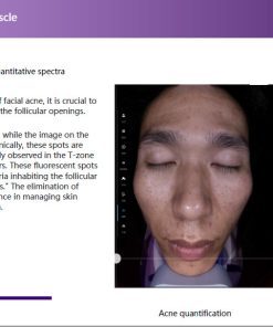 Soi mụn máy soi AISKIN